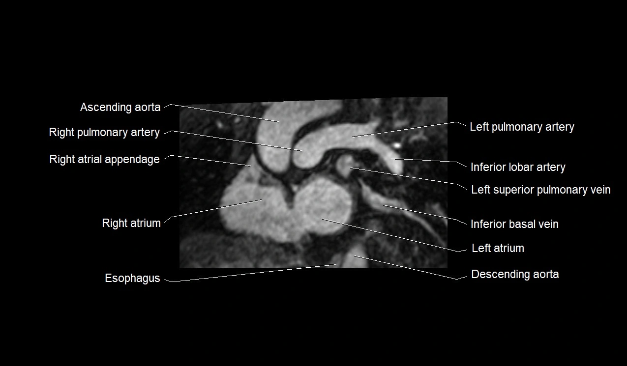 MRI heart and coronary arteries short axis anatomy image 11.webp